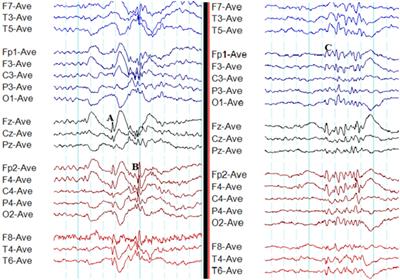 Normal Eeg Tracing